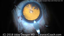 Beginning Surgeon Stop-and-Chop Cataract Surgery Case