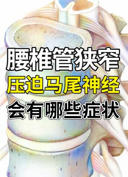 腰椎管狭窄压迫马尾神经