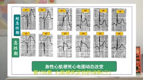 第106集 心肌梗死定位的诊断(三)